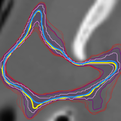 Contour boxplot that provides a statistical summary of an ensemble of contours of a slice of the right parotid gland of a head-and-neck cancer patient.