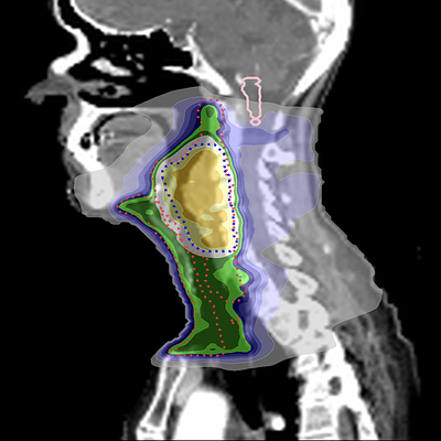 Brainstem (DICE=0.13, |∆D0.03cc| = 6.0%)