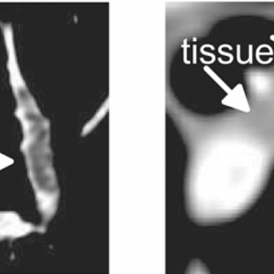  (a) In CT images, PE appears as a dark region inside the pulmonary arteries. (b) Lymphoid tissue and PE can have the same intensity.