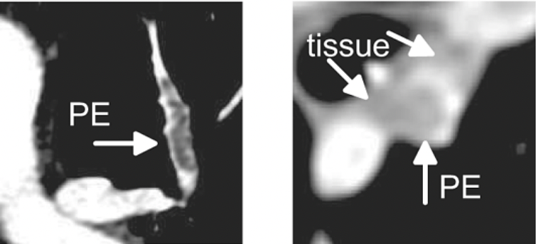  (a) In CT images, PE appears as a dark region inside the pulmonary arteries. (b) Lymphoid tissue and PE can have the same intensity.