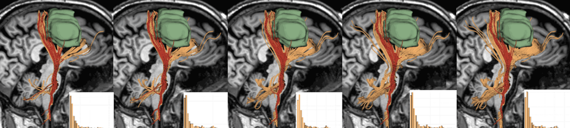 A Progressive Approach for Uncertainty Visualization in Diffusion Tensor Imaging