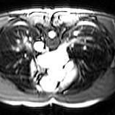  Slice of the MRI of the heart taken from the down-up sequence.