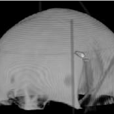 A CT dataset, missing a major part of the facial structures, which hinders the registration process.