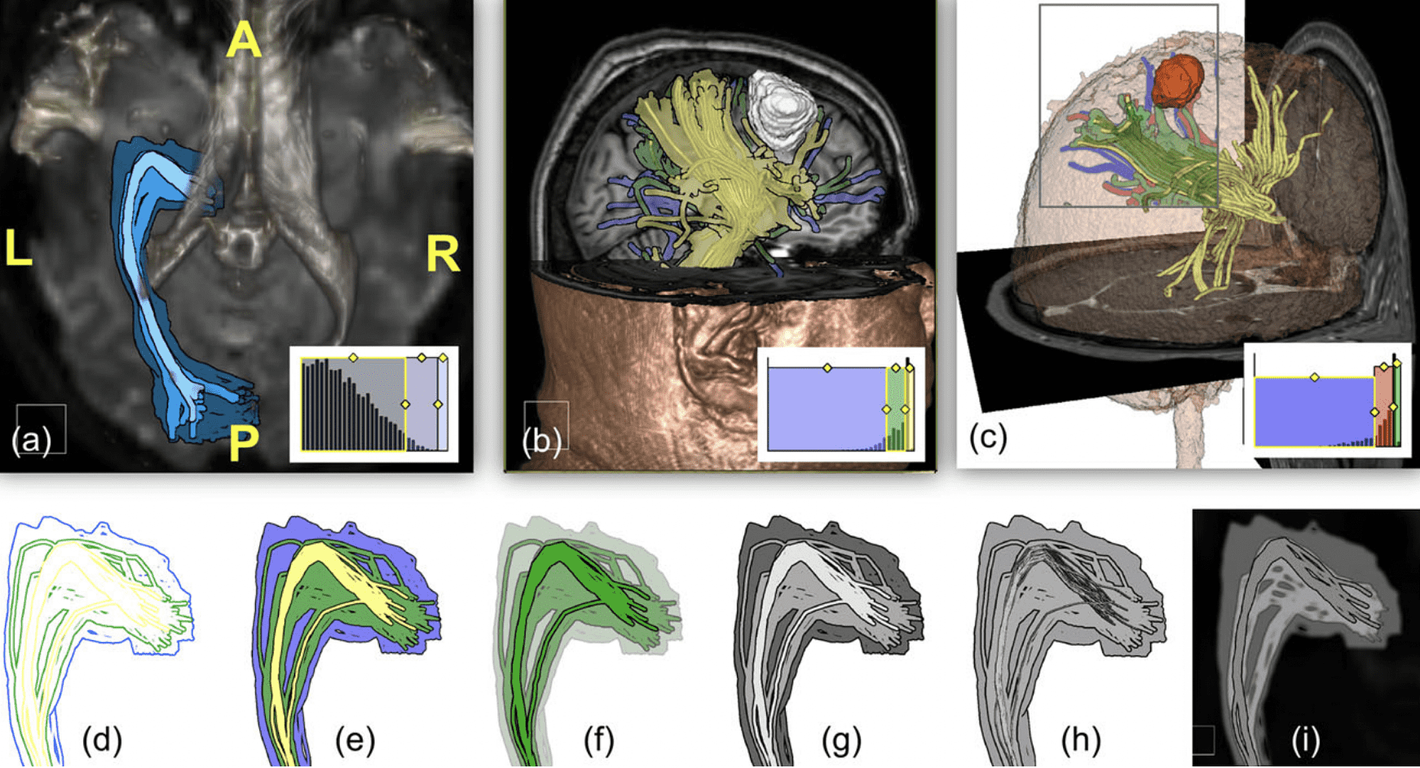 (a) Optic radiation, (b) pyramidal tract with tumor, (c) uncertainty lens, (d–i) different visual styles applied to optic radiation (warm-to-cool outlines, warm-to-cool surfaces, decreasing opacity, light-to-dark, increasing dilation, increasing blur)