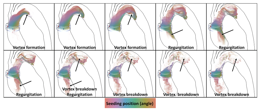 Streak visualization showing the formation, shedding and breakdown of a vortex in a patient with an aortic dissection in the aortic arch and regurgitation is present in the ascending aorta. The corresponding video can be found in the supporting material.