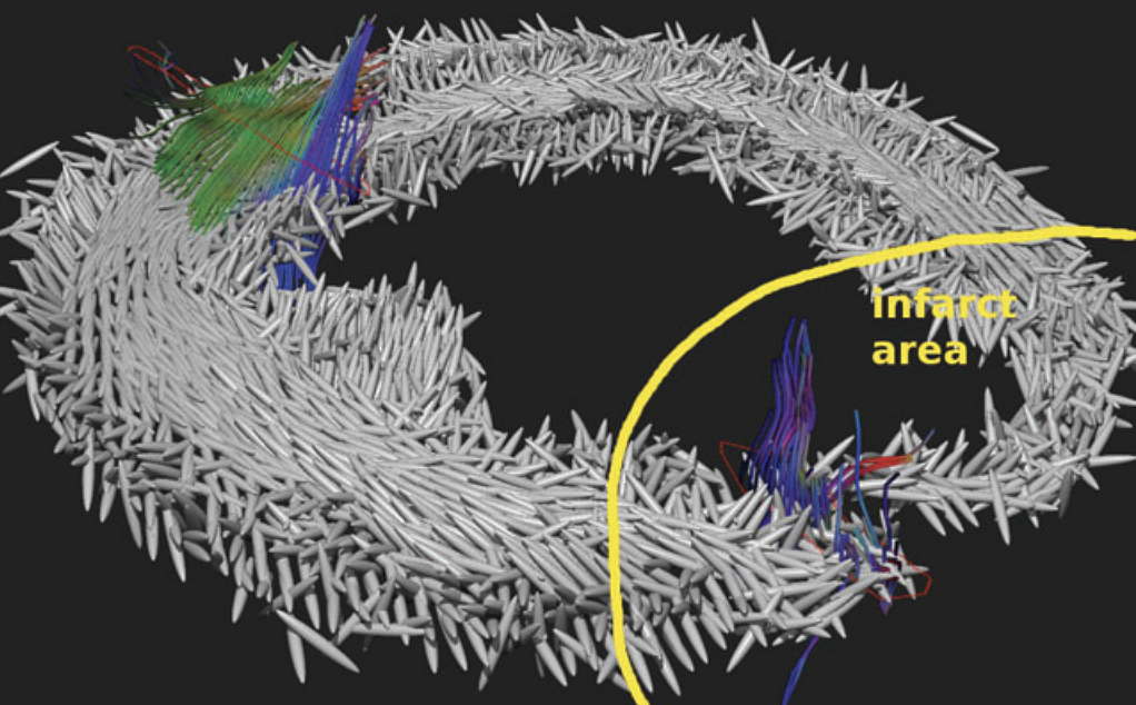 Our new rendering method using ellipsoids with fixed shape to show the fibre orientations in the cross section of an infarcted heart, which was scanned 28 days after the infarct. We also tracked fibres from two different seeding areas. The resulting fibres were rendered as thin tubes and RGB colouring of the fibre orientation was used.